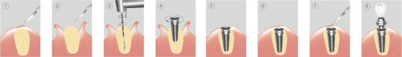 etapy leczenia implantologicznego