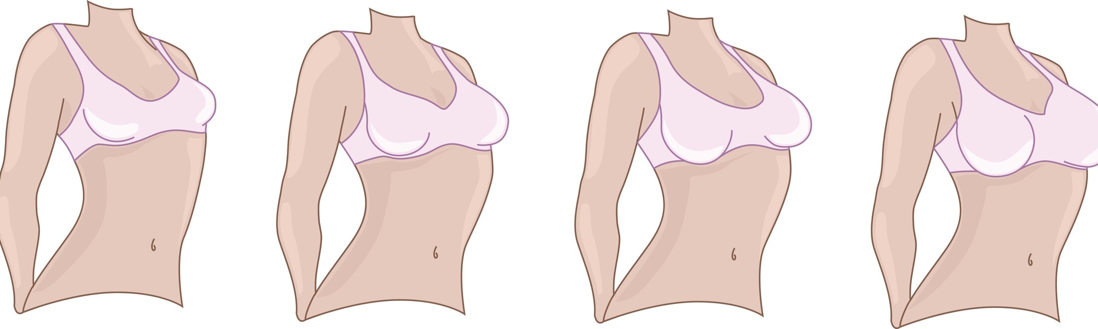 Powiększanie piersi - co musisz wiedzieć? 