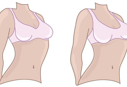 Powiększanie piersi - co musisz wiedzieć?