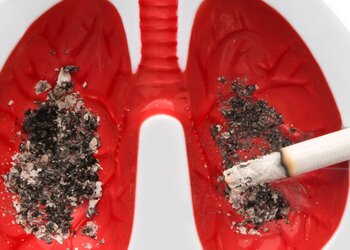 Rak płuca – główny zabójca wśród nowotworów