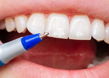 Fluoroza zębów: przyczyny, objawy i leczenie