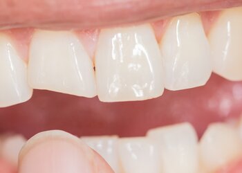 Złamany lub ukruszony ząb: co robić i czy da się go uratować?